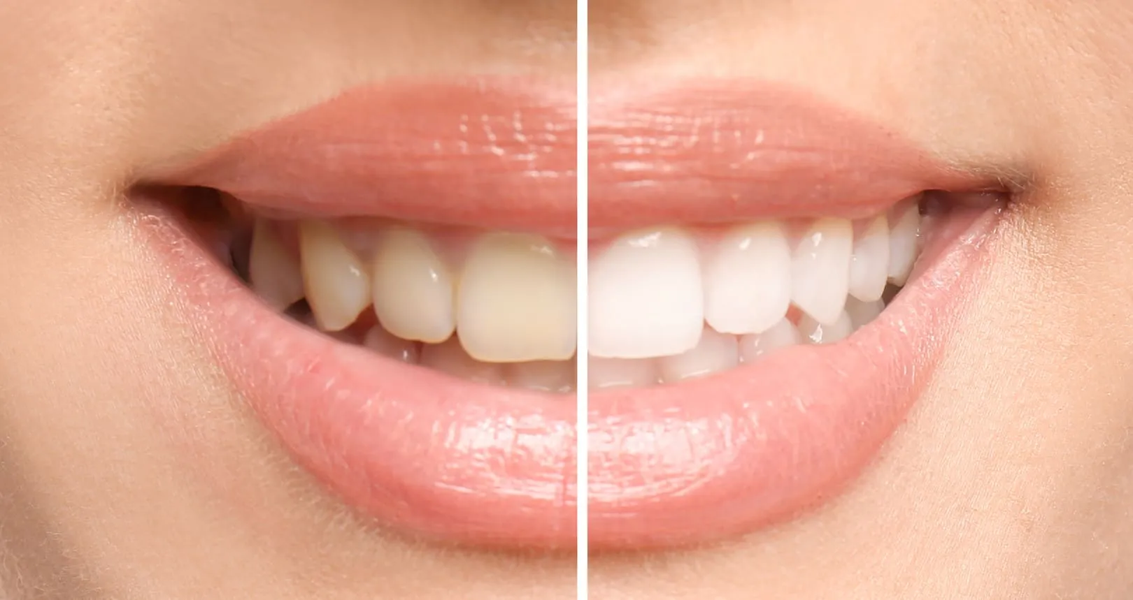 Close-up of smile showing teeth before and after whitening treatment divided by a vertical line.